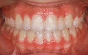 Case 3 After R & R Orthodontics in LaGrangeville and Fishkill, NY