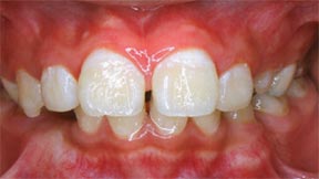 Case 4 After R & R Orthodontics in LaGrangeville and Fishkill, NY