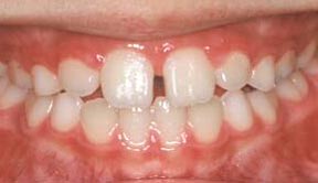 Case After 5 R & R Orthodontics in LaGrangeville and Fishkill, NY