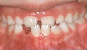 Case 5 Before R & R Orthodontics in LaGrangeville and Fishkill, NY