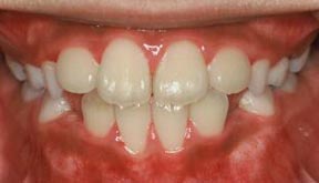Case 6 After R & R Orthodontics in LaGrangeville and Fishkill, NY