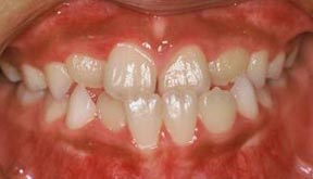 Case 6 Before R & R Orthodontics in LaGrangeville and Fishkill, NY