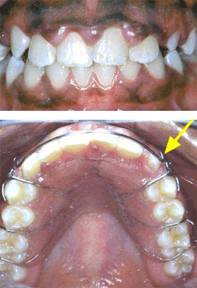 Case 8 After R & R Orthodontics in LaGrangeville and Fishkill, NY
