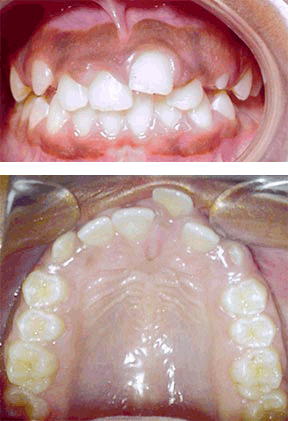 Case 8 Before R & R Orthodontics in LaGrangeville and Fishkill, NY