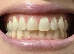 Virtual-Orthodontic-Consultation-Front-Bite-Example