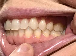 Virtual-Orthodontic-Consultation-Right-Bite-Example