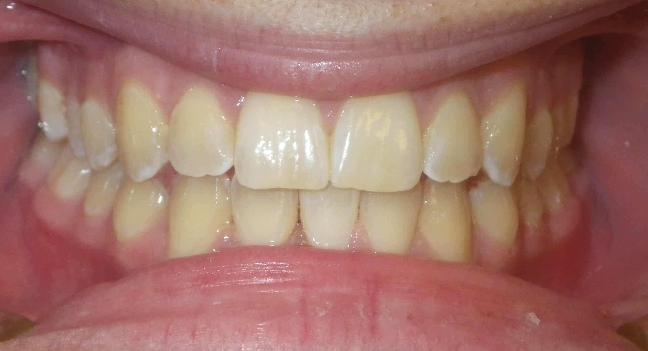 Underbite Treated With Removal Of A Lower Incisor - AFTER