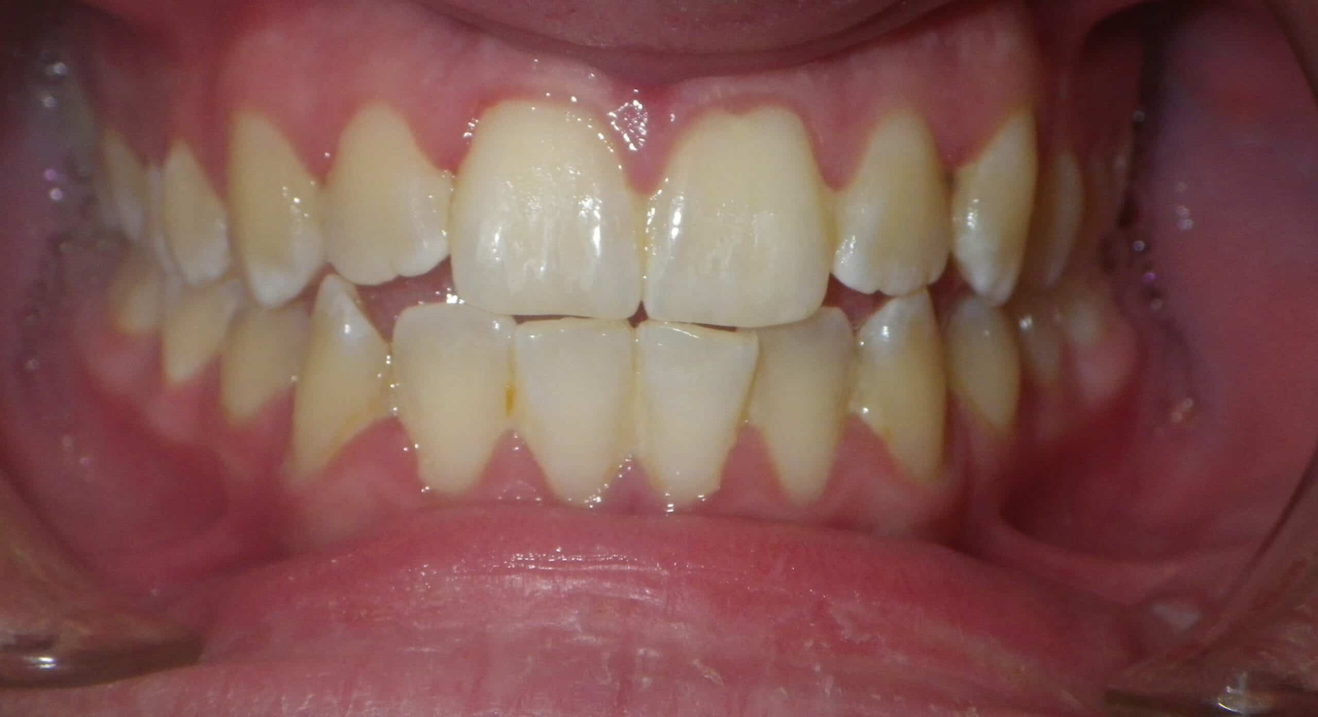 Underbite Treated With Removal Of A Lower Incisor - BEFORE