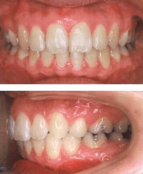 Case 1 After R & R Orthodontics in LaGrangeville and Fishkill, NY