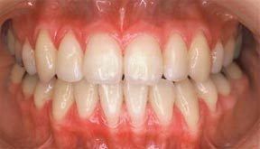 Case 2 After R & R Orthodontics in LaGrangeville and Fishkill, NY