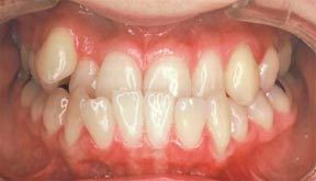 Case 2 Before R & R Orthodontics in LaGrangeville and Fishkill, NY