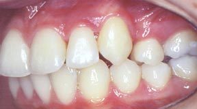 Case 7 After R & R Orthodontics in LaGrangeville and Fishkill, NY
