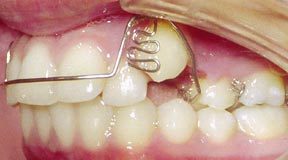 Case 7 Before R & R Orthodontics in LaGrangeville and Fishkill, NY
